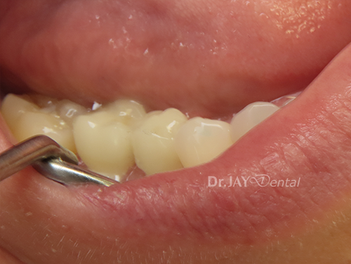 Case 12 after ceramic dental implant treatment