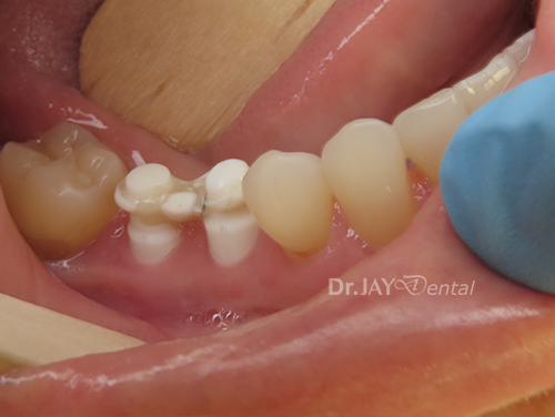 Case 12 before ceramic dental implant treatment