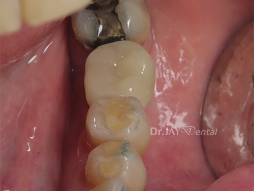 Case 4 after ceramic dental implant treatment