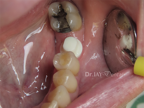 Case 4 before ceramic dental implant treatment