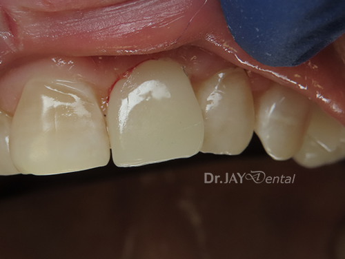 Case 6 after ceramic dental implant treatment