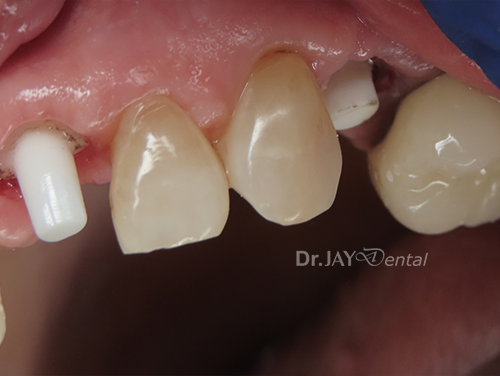 Case 6 before ceramic dental implant treatment