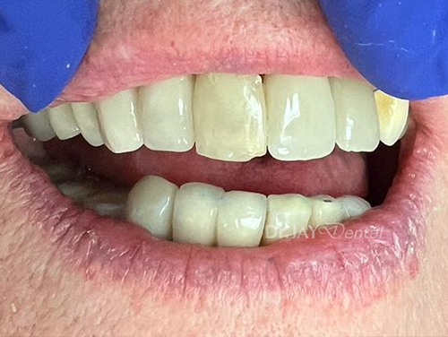 Front teeth after ceramic dental implant treatment