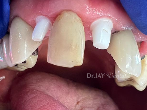Front teeth before ceramic dental implant treatment