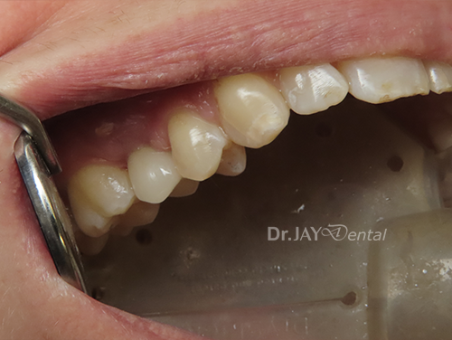 Case 10 after ceramic dental implant treatment