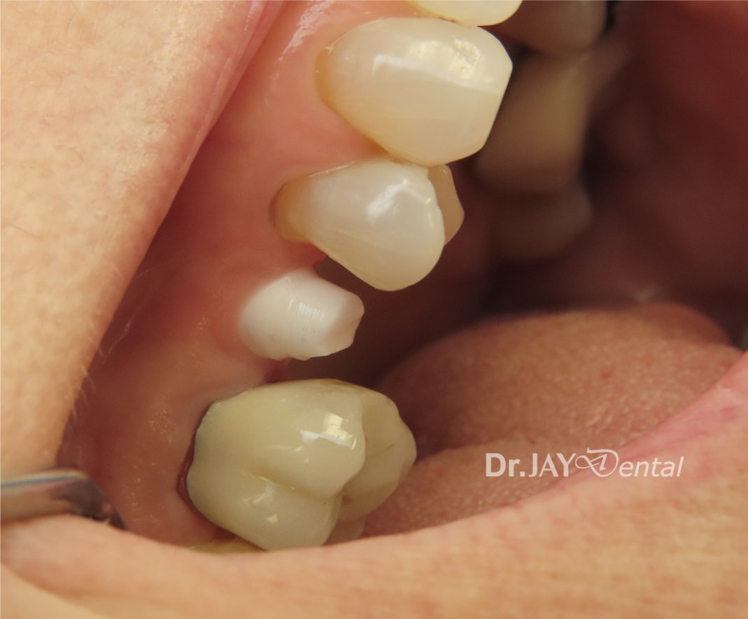 Case 13 before ceramic dental implant treatment