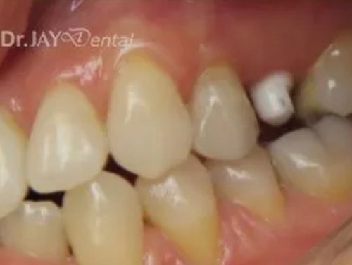 Case 14 ceramic dental implant treatment