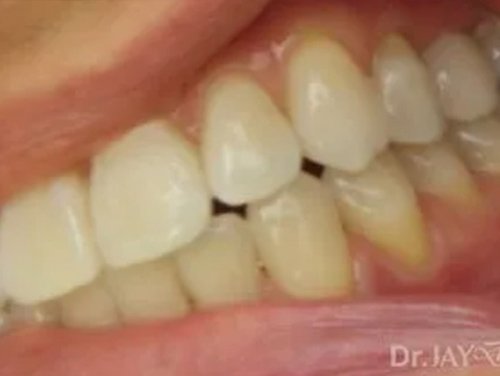 Case 14 ceramic dental implant treatment