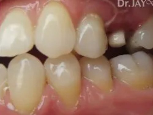Case 14 ceramic dental implant treatment