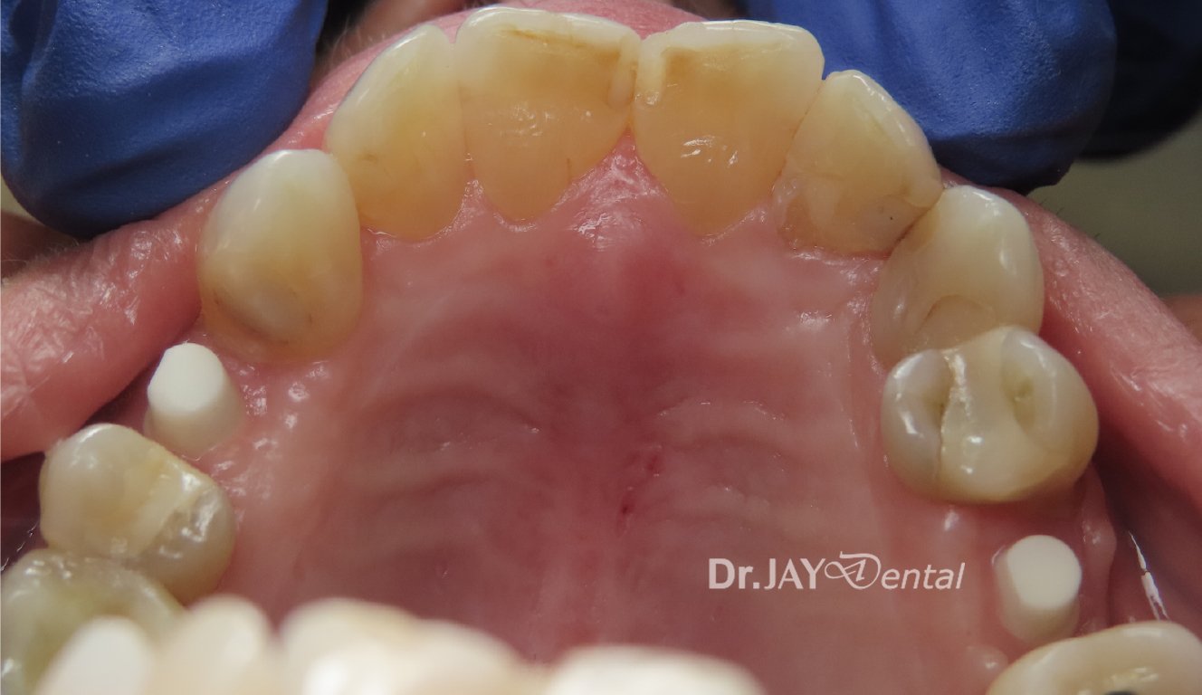 Case 7 ceramic dental implant treatment